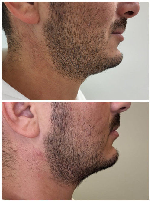 Hifu SMAS procedūra vyrams prieš ir po iš šono