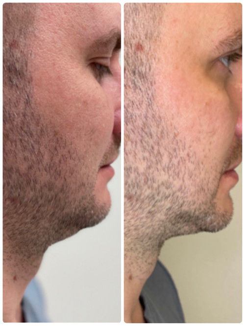 Hifu SMAS veido procedūra vyrams