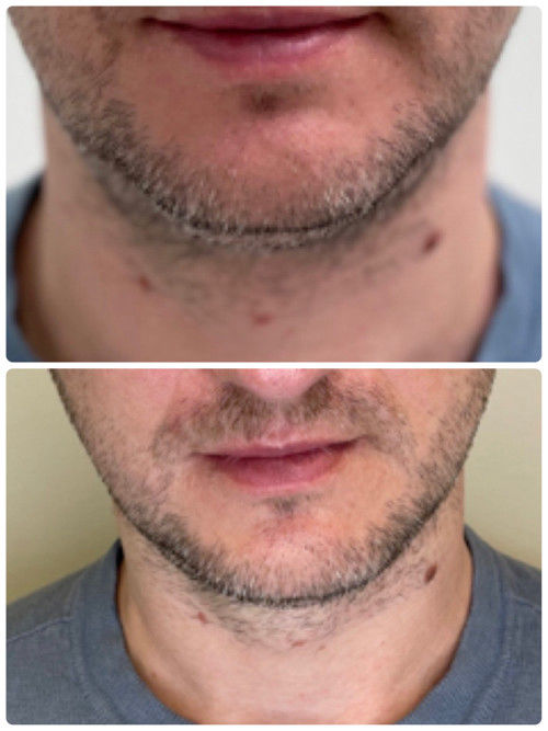 Hifu SMAS procedūra vyrams prieš ir po