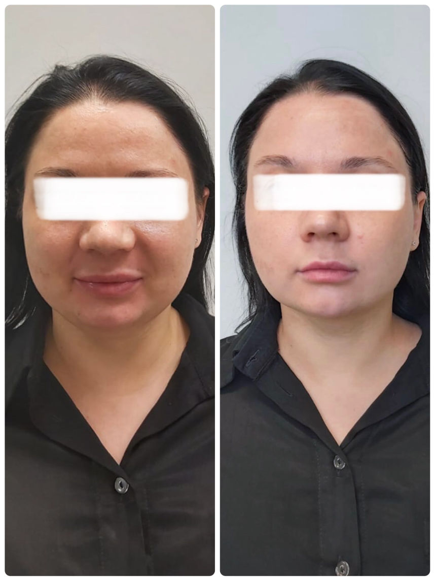 Hifu SMAS procedūra prieš ir po