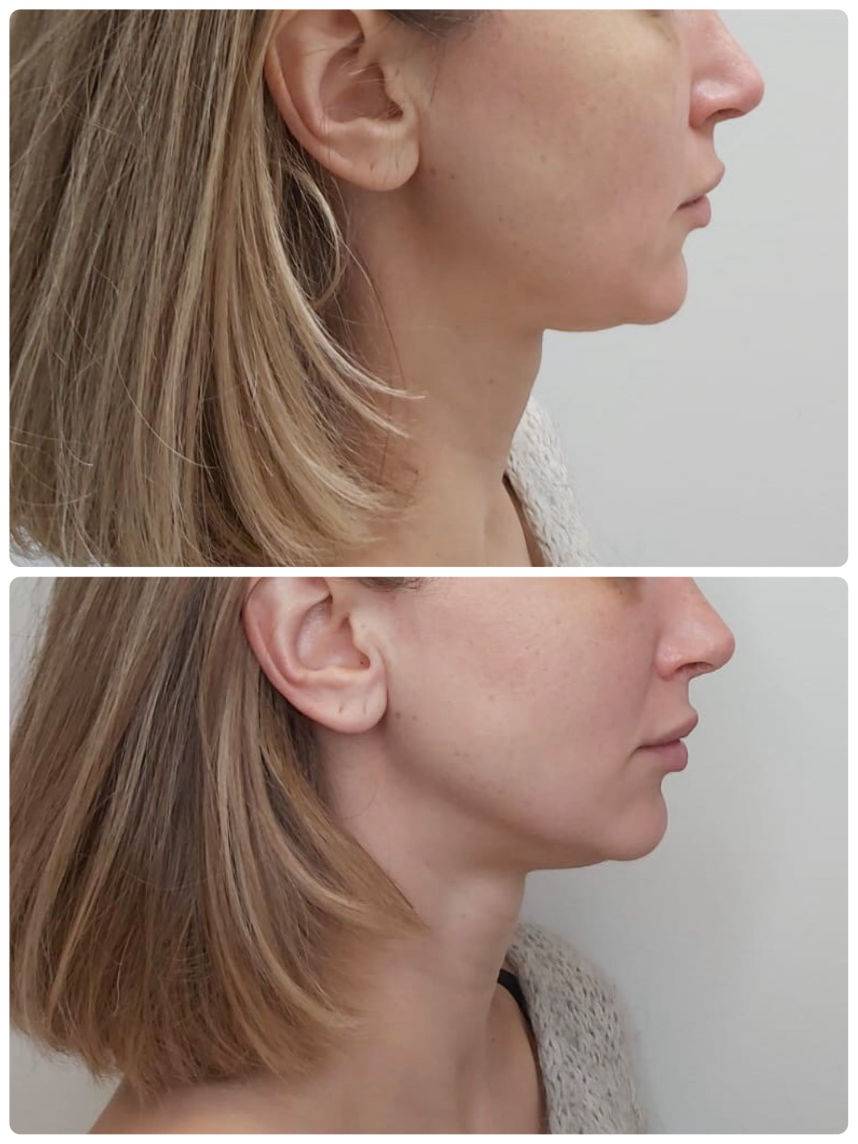 Hifu SMAS veido procedūra