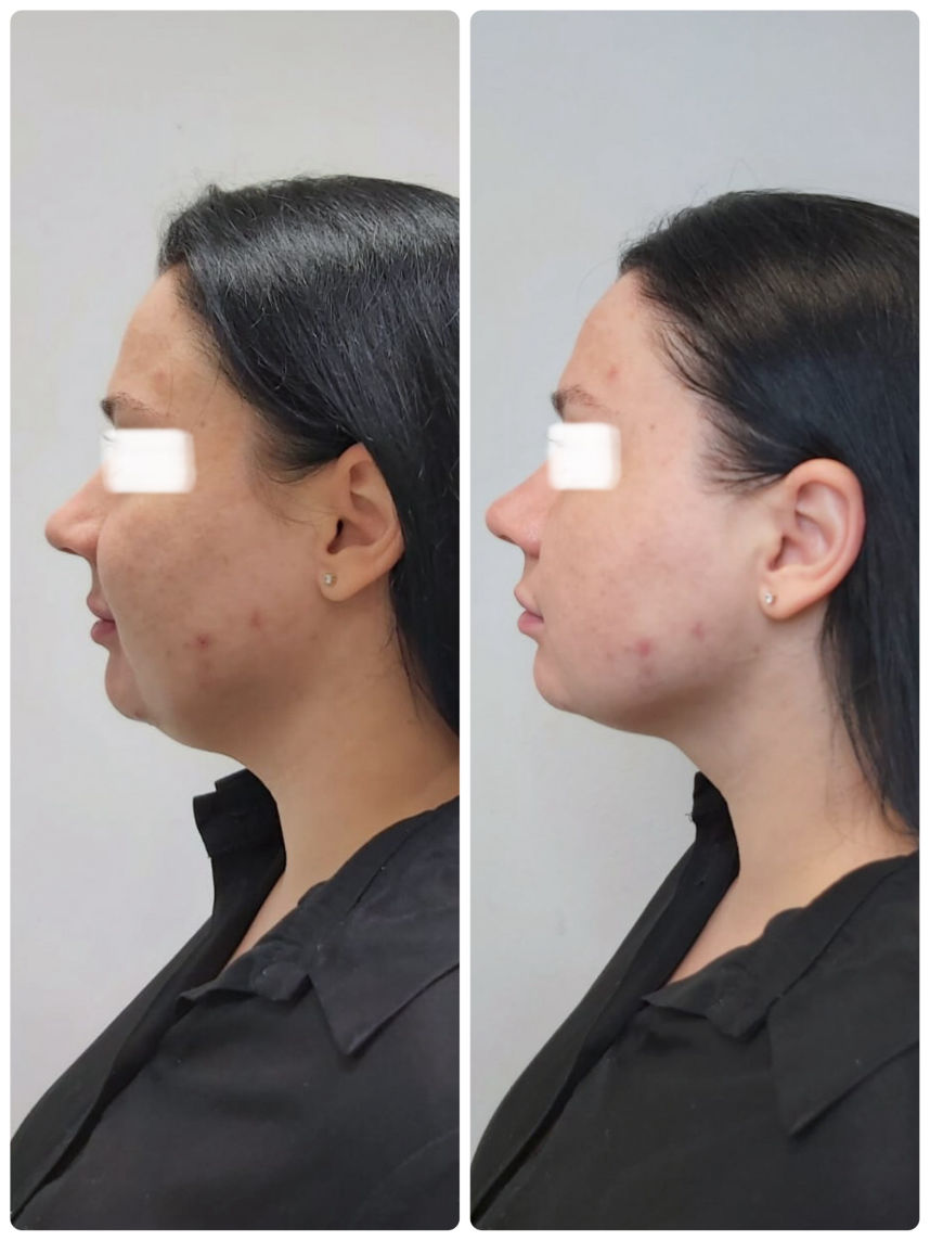 Hifu SMAS procedūra prieš ir po iš šono